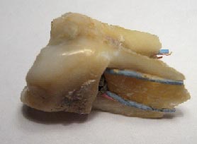 broken root canal treated tooth 