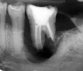 root canal treated tooth radiography
